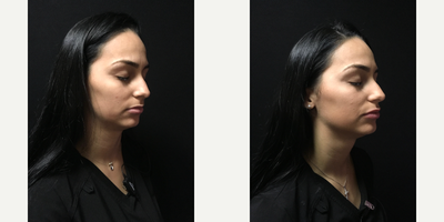 Juvederm before and after photo