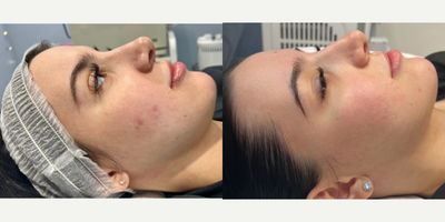 Skin Rejuvenation before and after photo