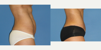 Tummy Tuck before and after photo