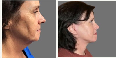 Deep Plane Facelift before and after photo