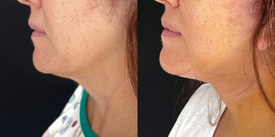 Facelift before and after photo