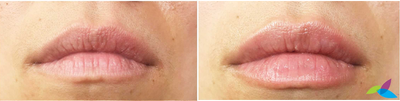 Volbella before and after photo