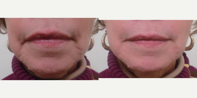 Juvederm before and after photo