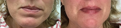 Juvederm before and after photo