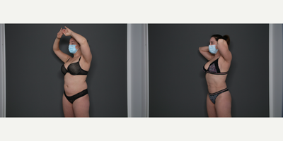 Liposuction before and after photo