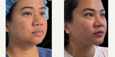 Nonsurgical Neck Lift before and after photo