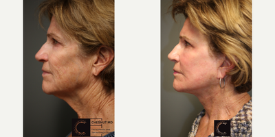 before and after image