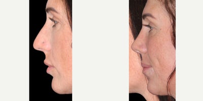 Rhinoplasty before and after photo