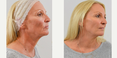 Ultherapy before and after photo