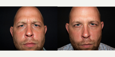 Botox before and after photo