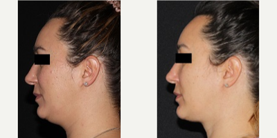 Chin Liposuction before and after photo