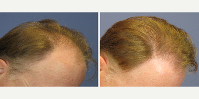 FUE Hair Transplant before and after photo