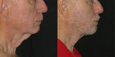 Neck Lift before and after photo
