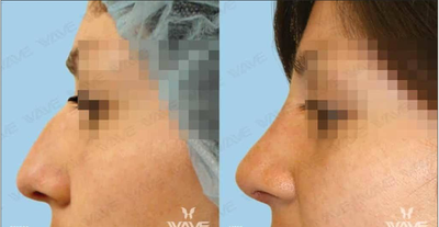 Rhinoplasty before and after photo