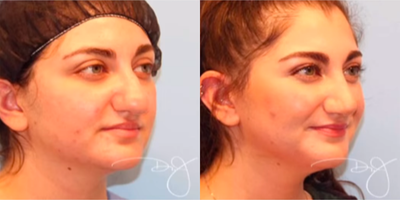 Rhinoplasty before and after photo
