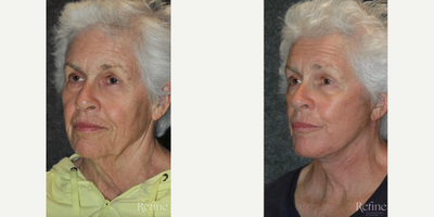 Deep Plane Facelift before and after photo