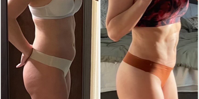 Liposuction before and after photo