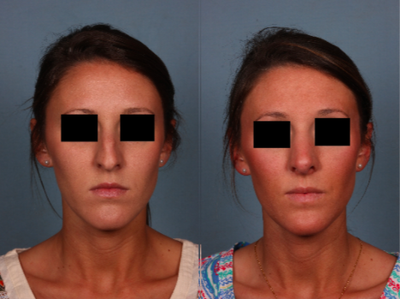 Rhinoplasty before and after photo