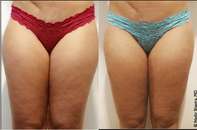 Smart Lipo before and after photo