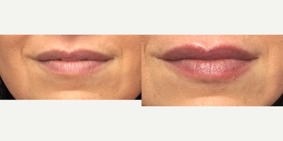 Lip Fillers before and after photo