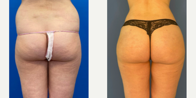 Brazilian Butt Lift before and after photo