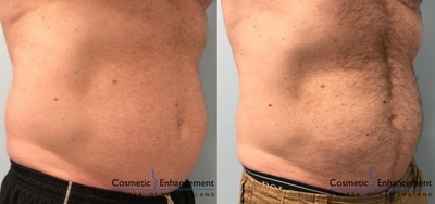 CoolSculpting before and after photo