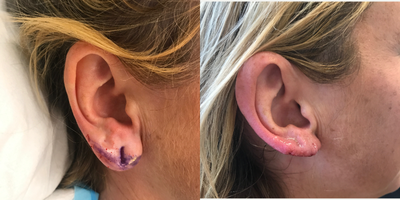 Earlobe Repair before and after photo
