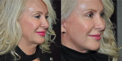 Facelift before and after photo