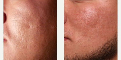 Scar Removal before and after photo