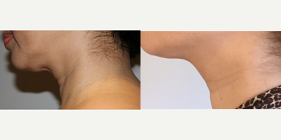 Thread Lift before and after photo