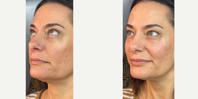 Belotero before and after photo