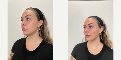 Contour Thread Lift before and after photo