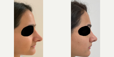 Revision Rhinoplasty before and after photo