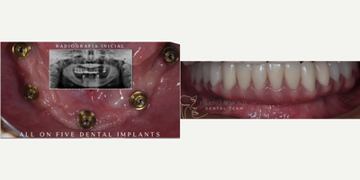 All-on-4 Dental Implants before and after photo