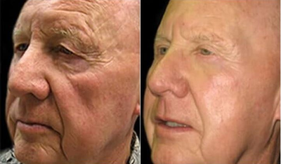 Cheek Lift before and after photo
