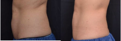 CoolSculpting before and after photo