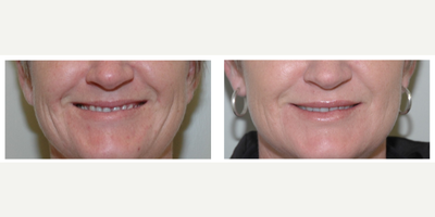 Dermal Fillers before and after photo