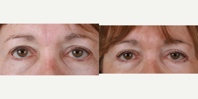 Eyelid Surgery before and after photo