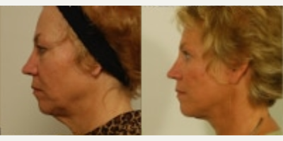 Facelift before and after photo