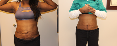truSculpt before and after photo
