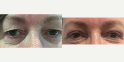 Eyelid Surgery before and after photo