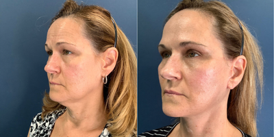 Facelift before and after photo