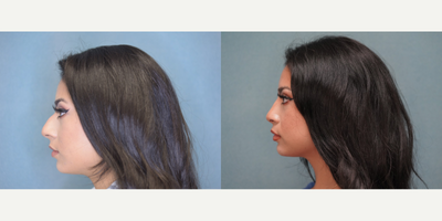 Rhinoplasty before and after photo