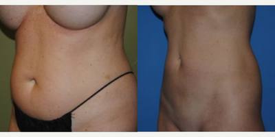 Smart Lipo before and after photo