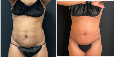 Tummy Tuck before and after photo