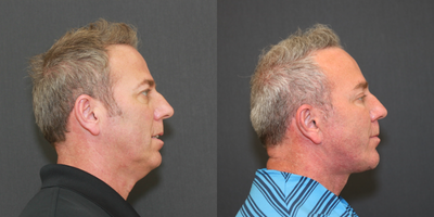 Chin Implant before and after photo