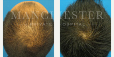 FUE Hair Transplant before and after photo