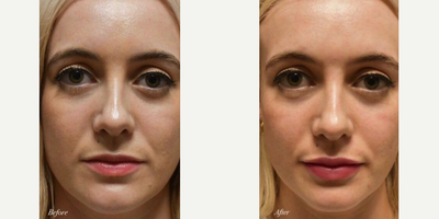 Juvederm before and after photo