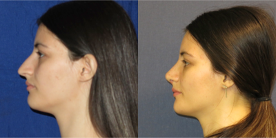 Rhinoplasty before and after photo