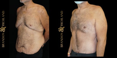 Body Lift before and after photo